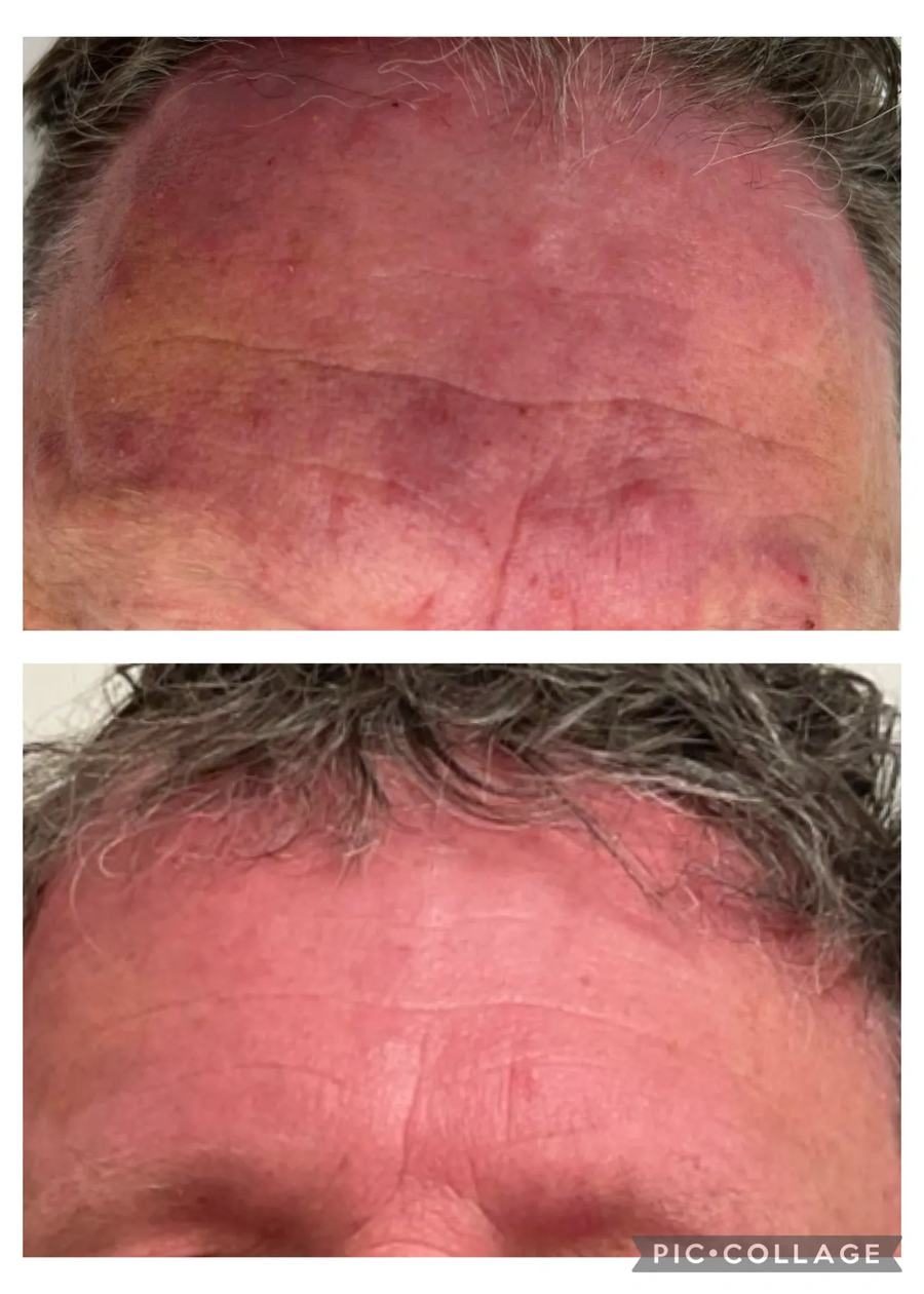 Acne Boot Camp · before and after