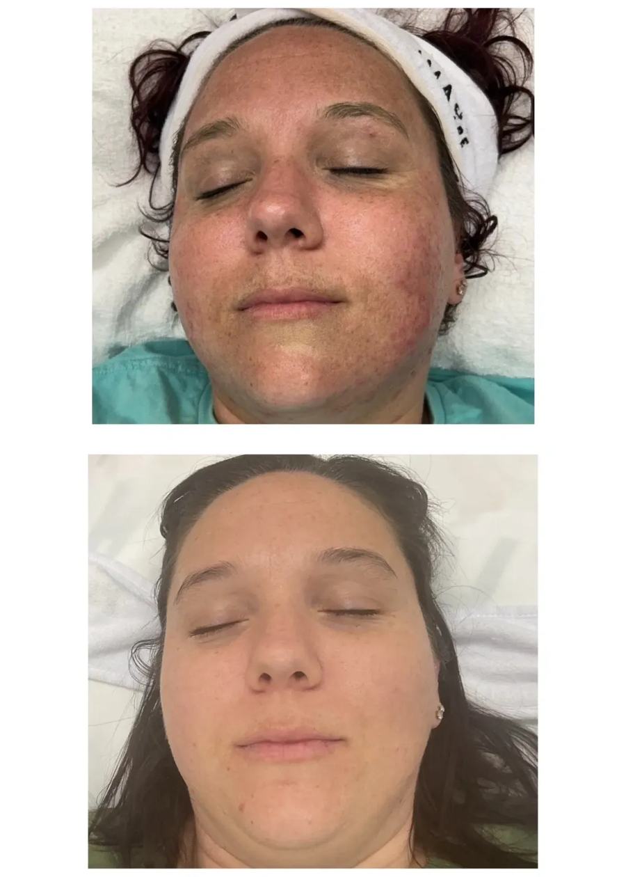 Acne Boot Camp · before and after
