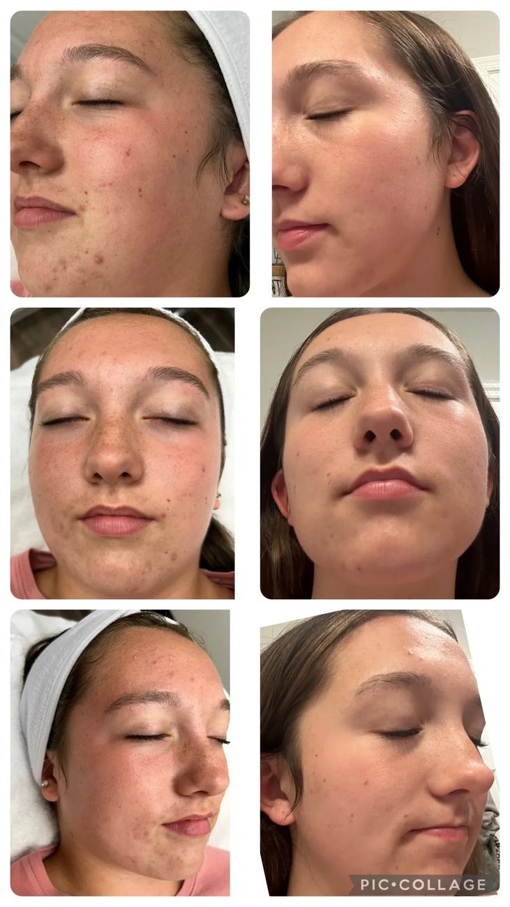 Acne Boot Camp · before and after