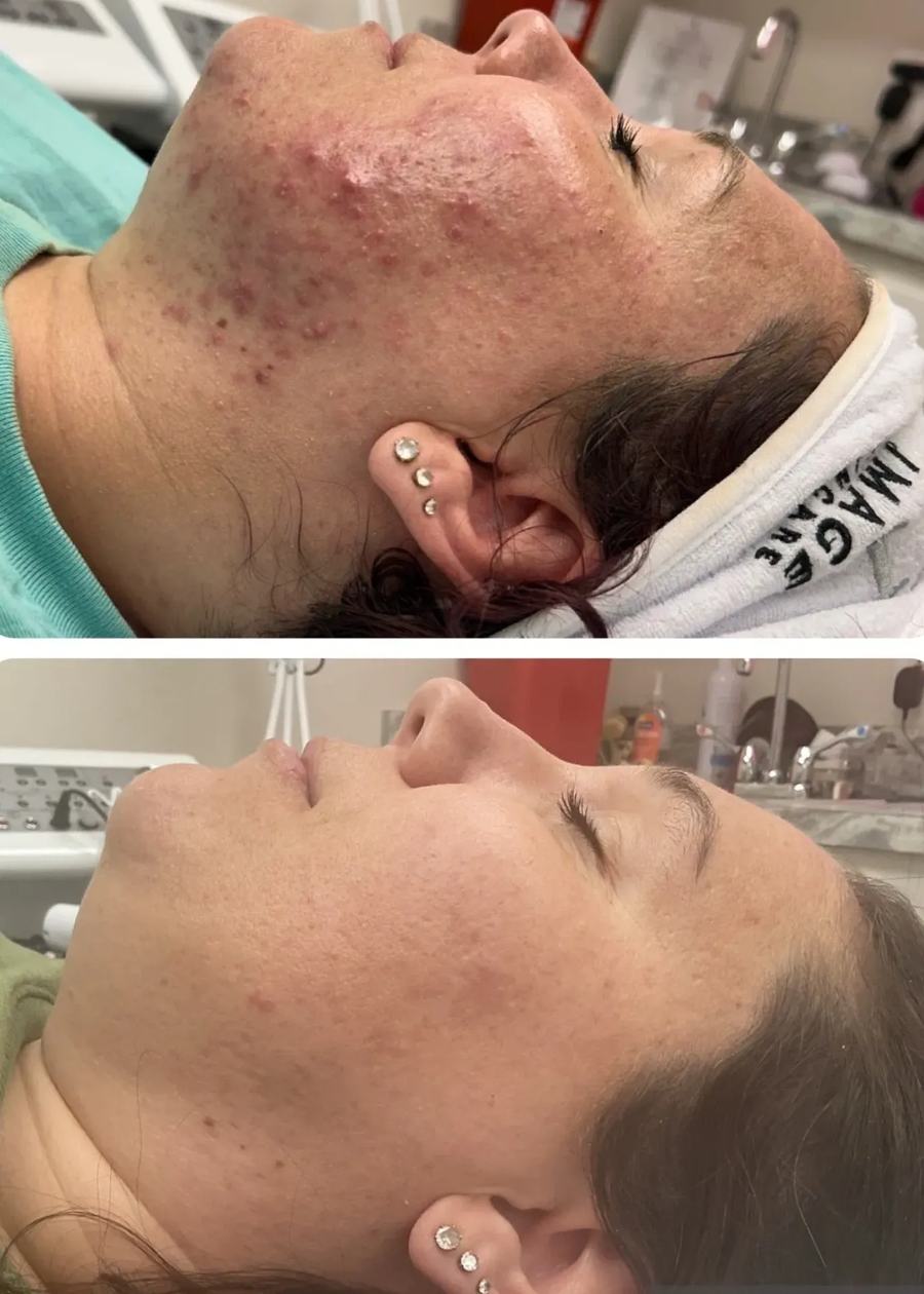 Acne Boot Camp · before and after
