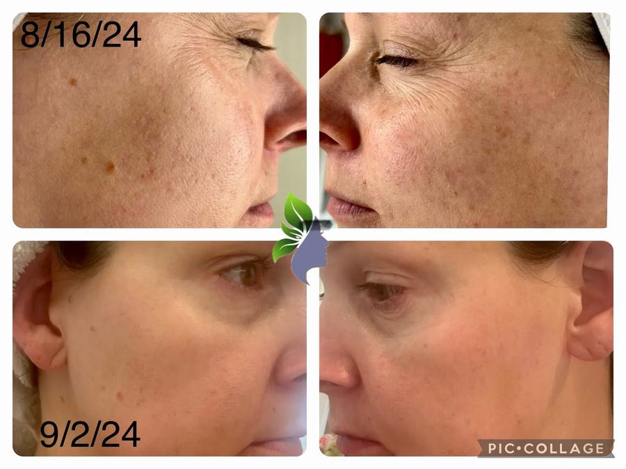 ProCell Microchanneling · before and after