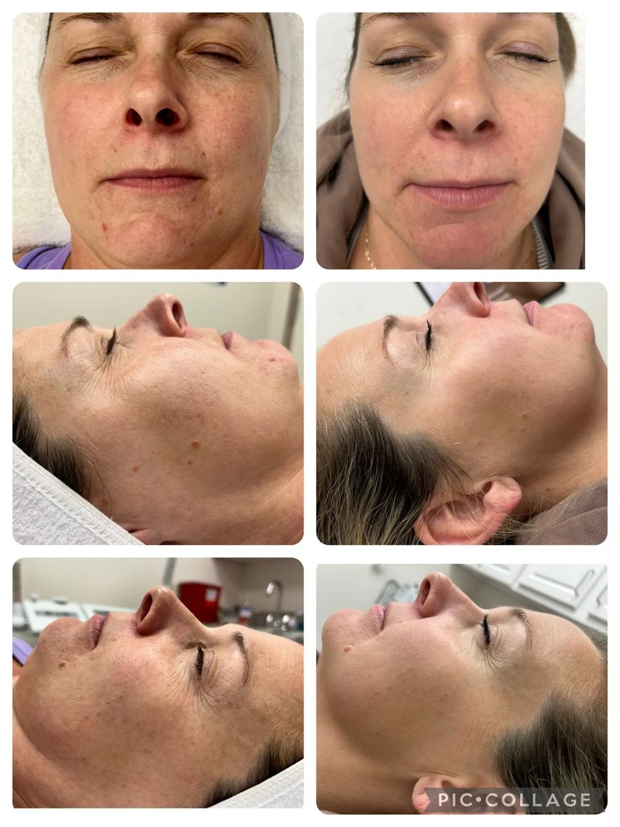 ProCell Microchanneling · before and after