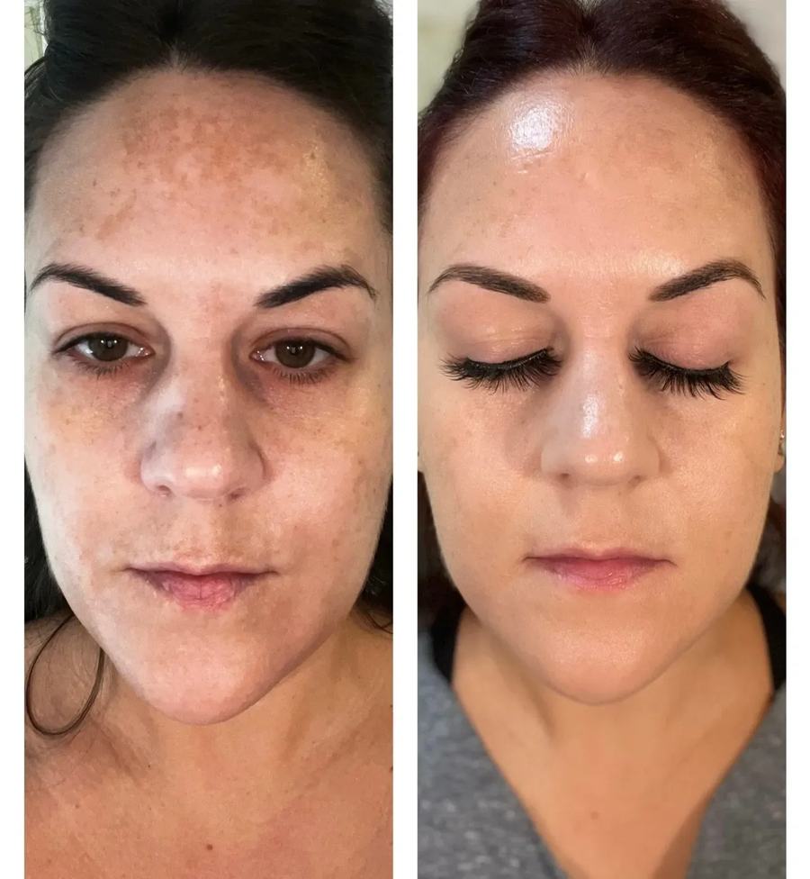 ProCell Microchanneling · before and after